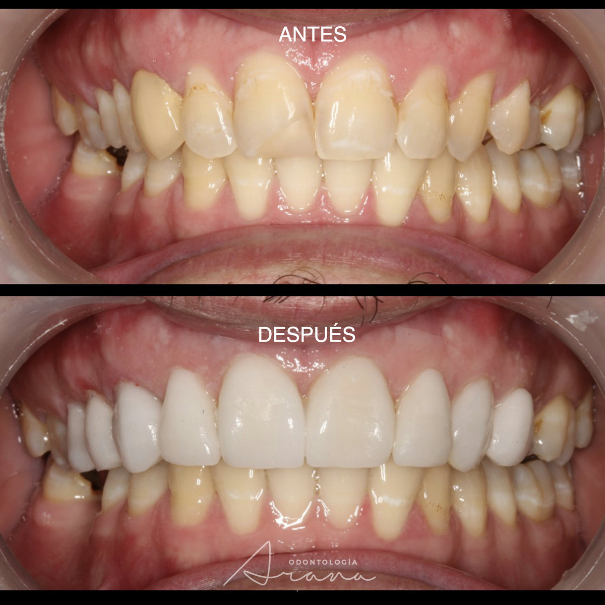 Carillas cerámicas — vista intraoral antes y después