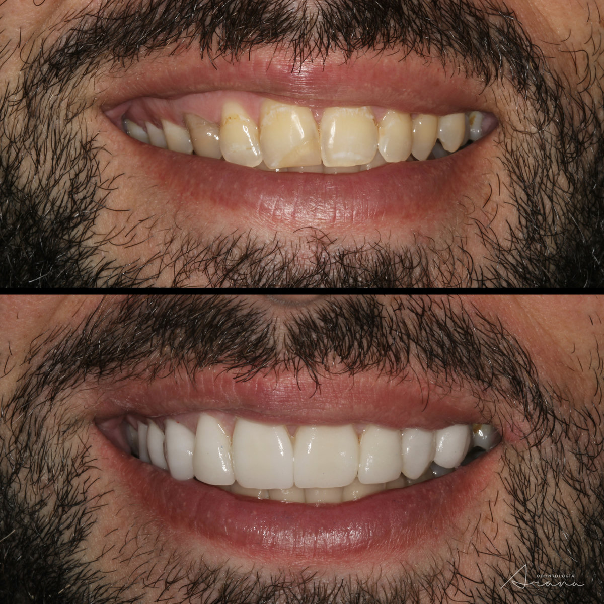 Carillas cerámicas — sonrisa antes y después