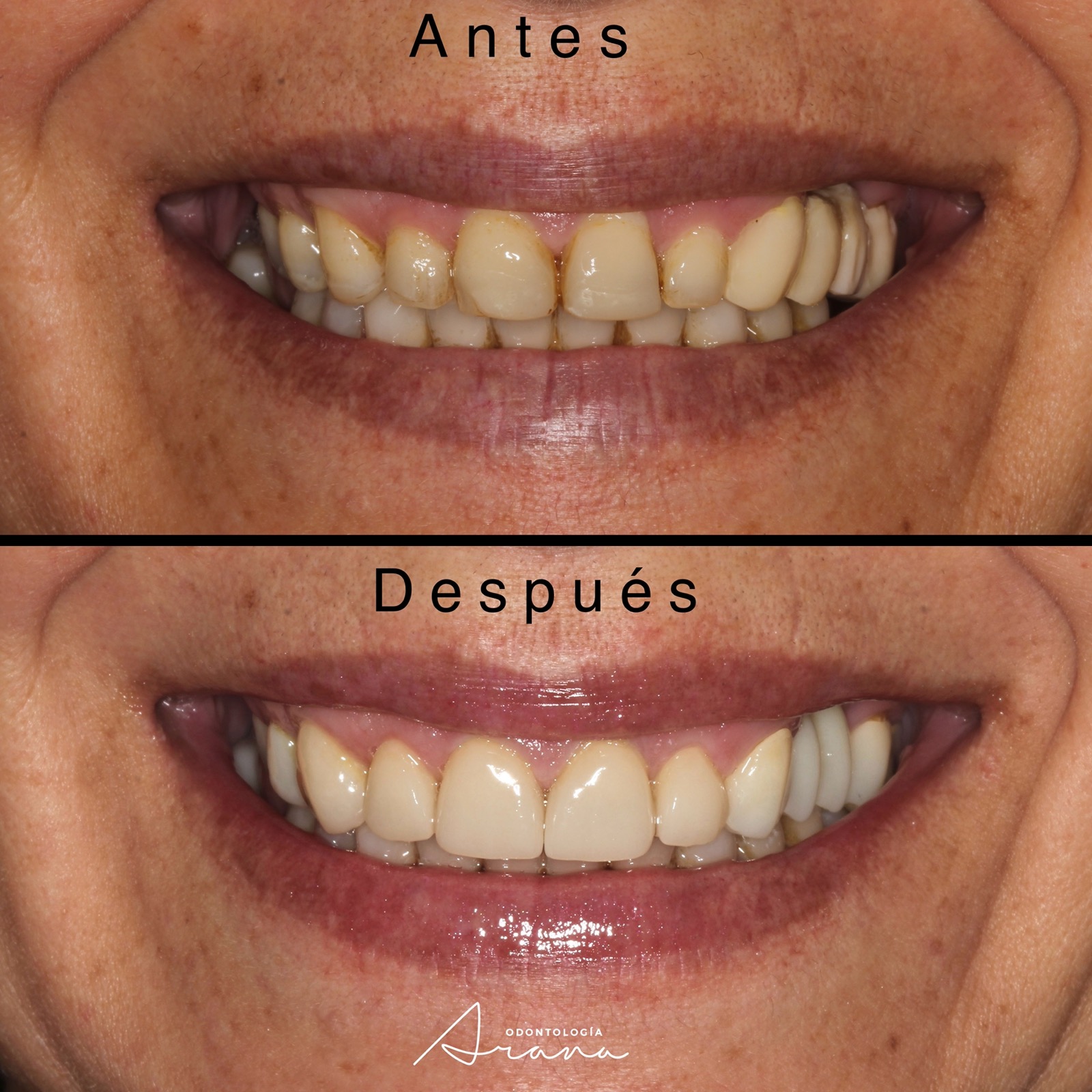 Carillas cerámicas — vista extraoral antes y después