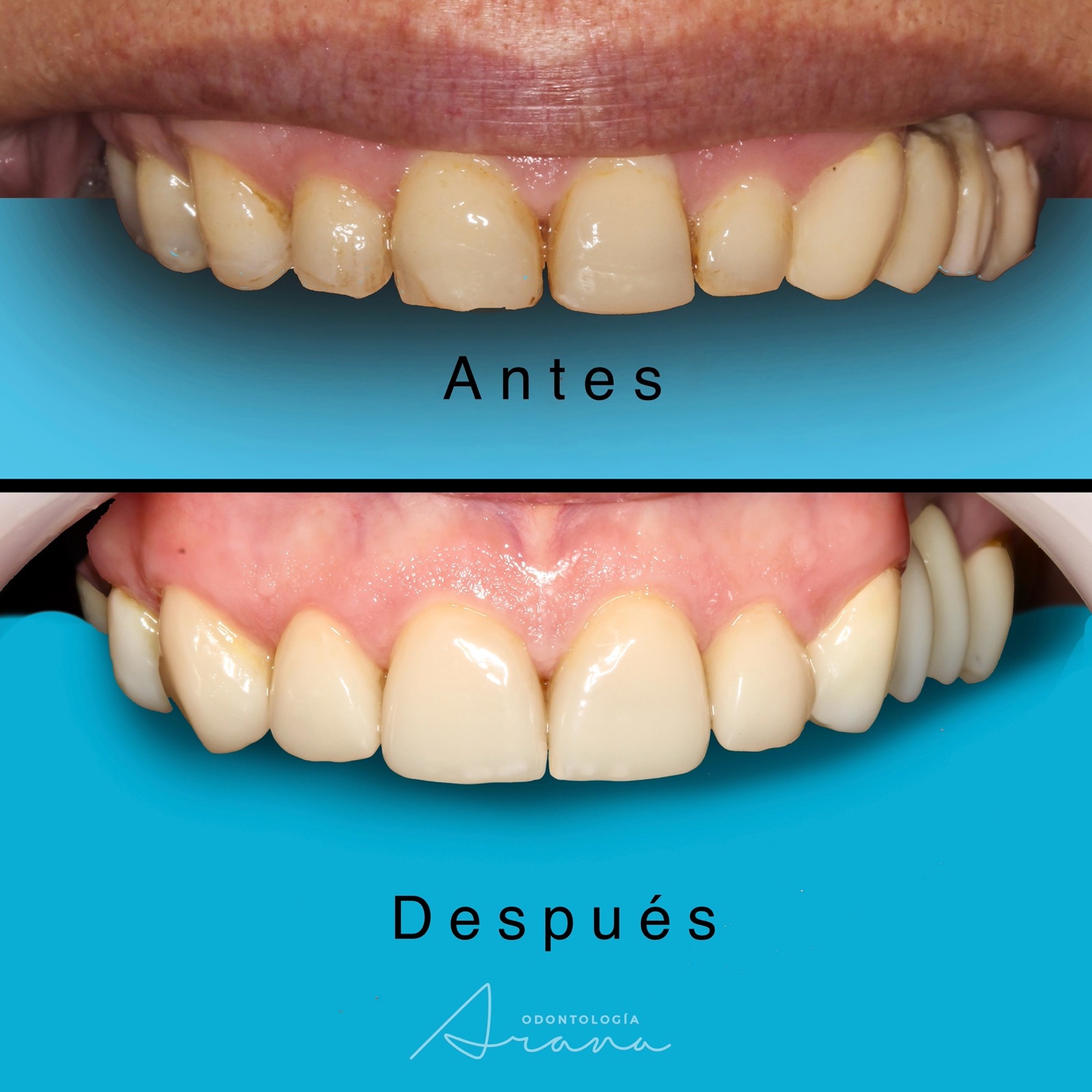 Carillas cerámicas — vista intraoral antes y después