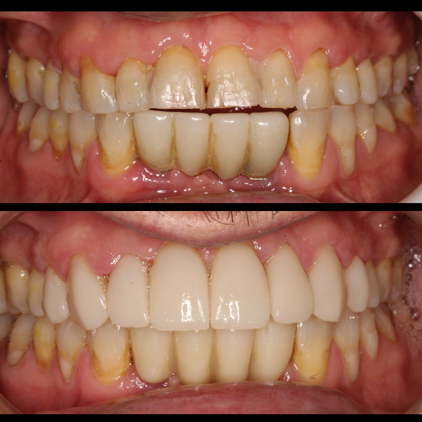 Carillas cerámicas — vista intraoral antes y después