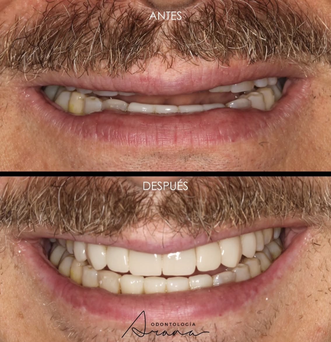 Carillas cerámicas — sonrisa antes y después