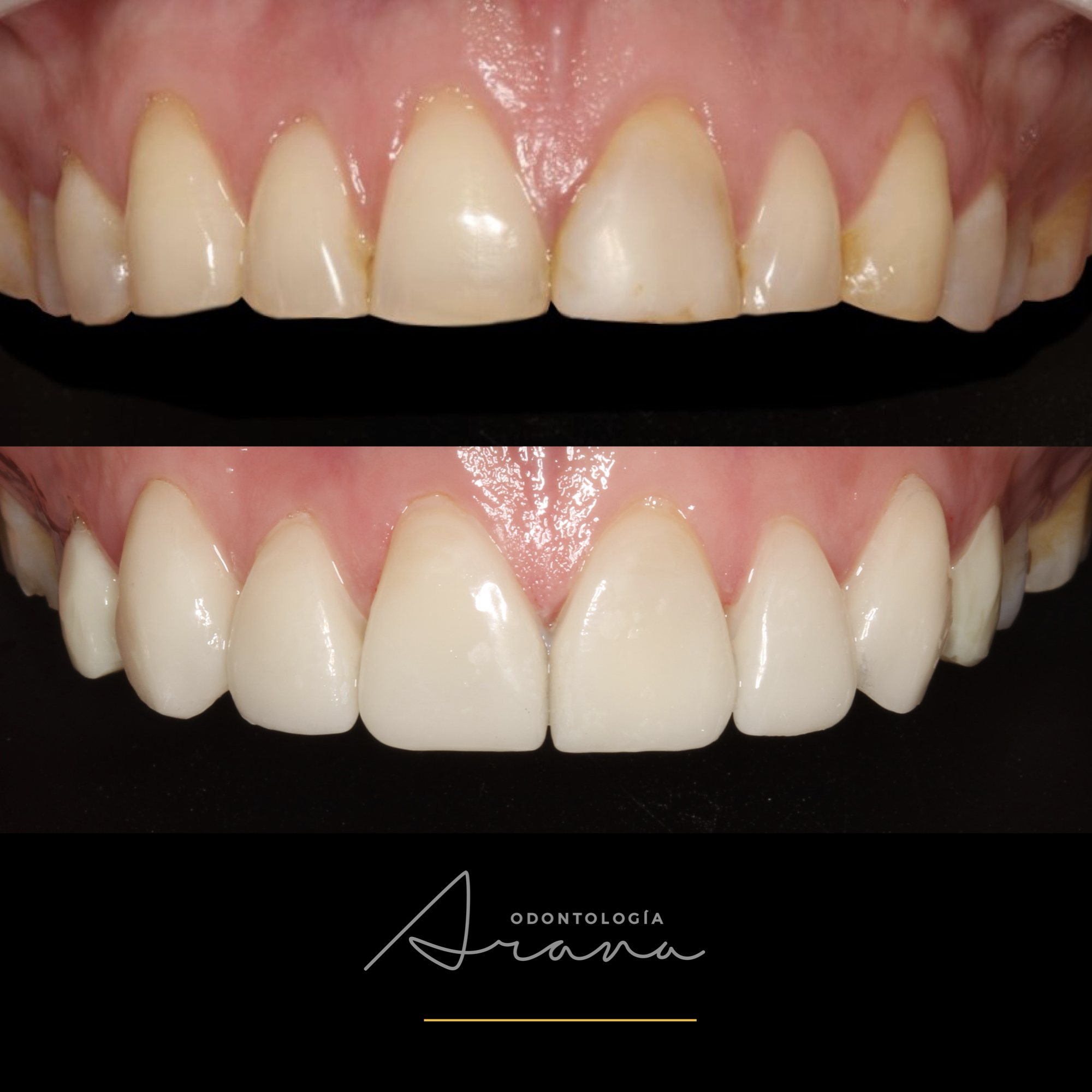 Carillas cerámicas — vista intraoral antes y después