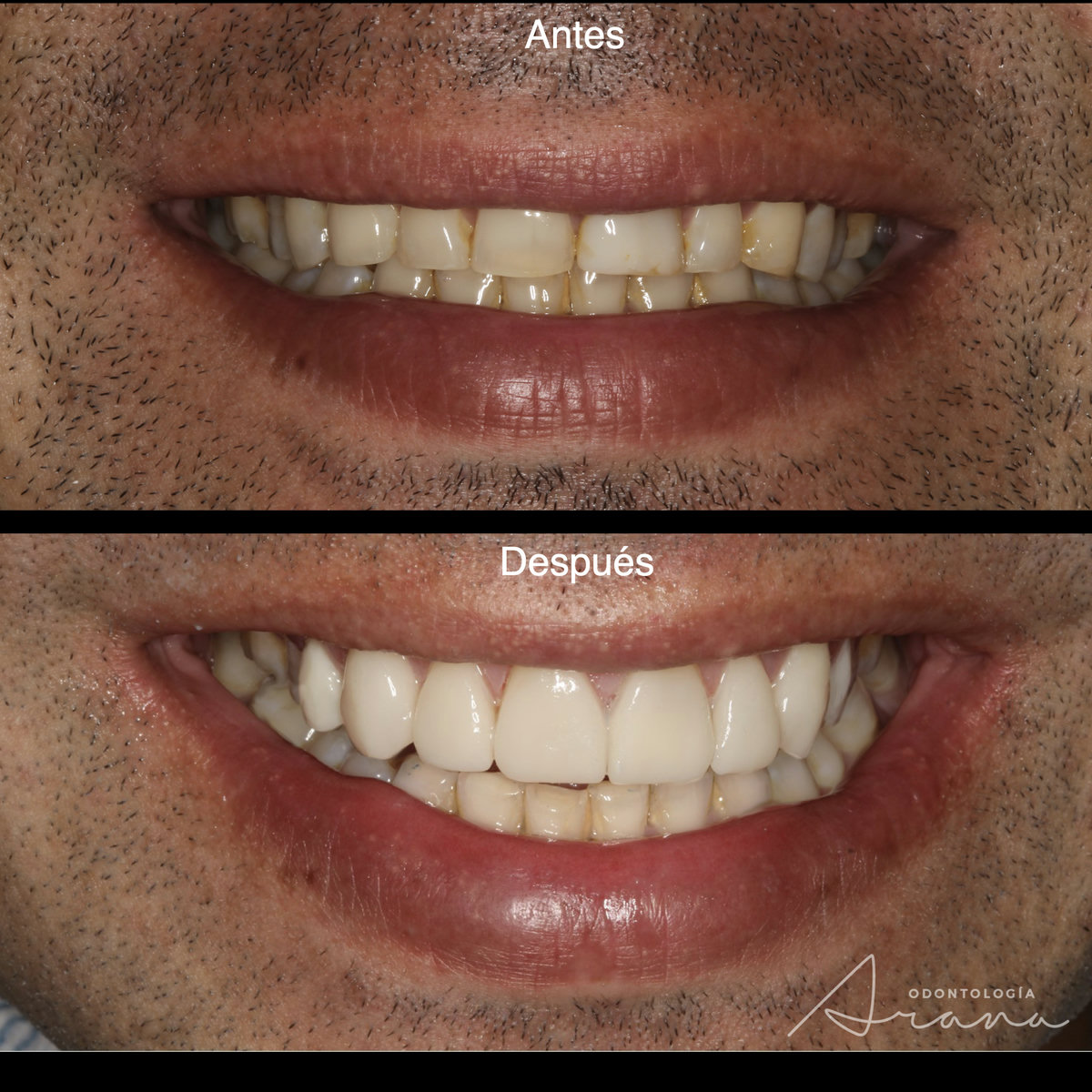 Carillas cerámicas — sonrisa antes y después