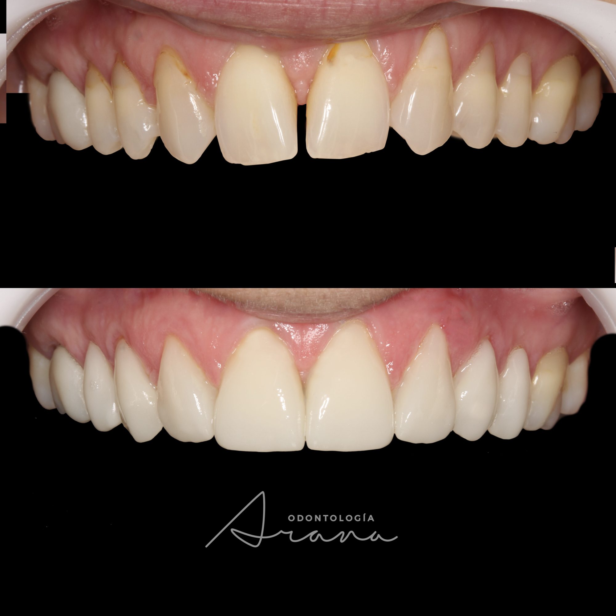 Carillas cerámicas — vista intraoral antes y después