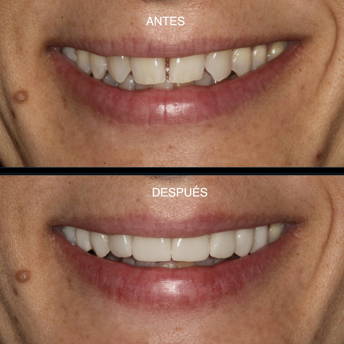 Carillas cerámicas — sonrisa antes y después