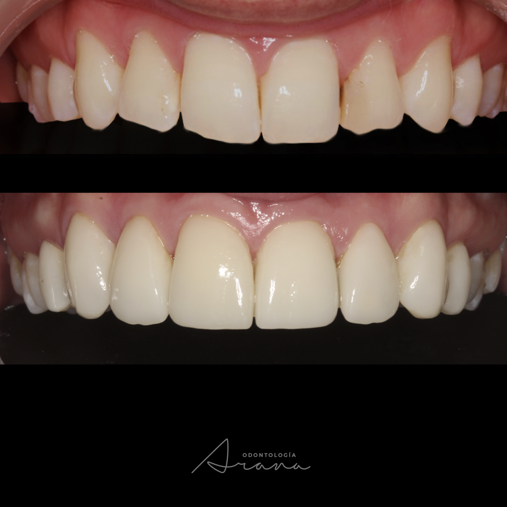 Carillas cerámicas — vista intraoral antes y después