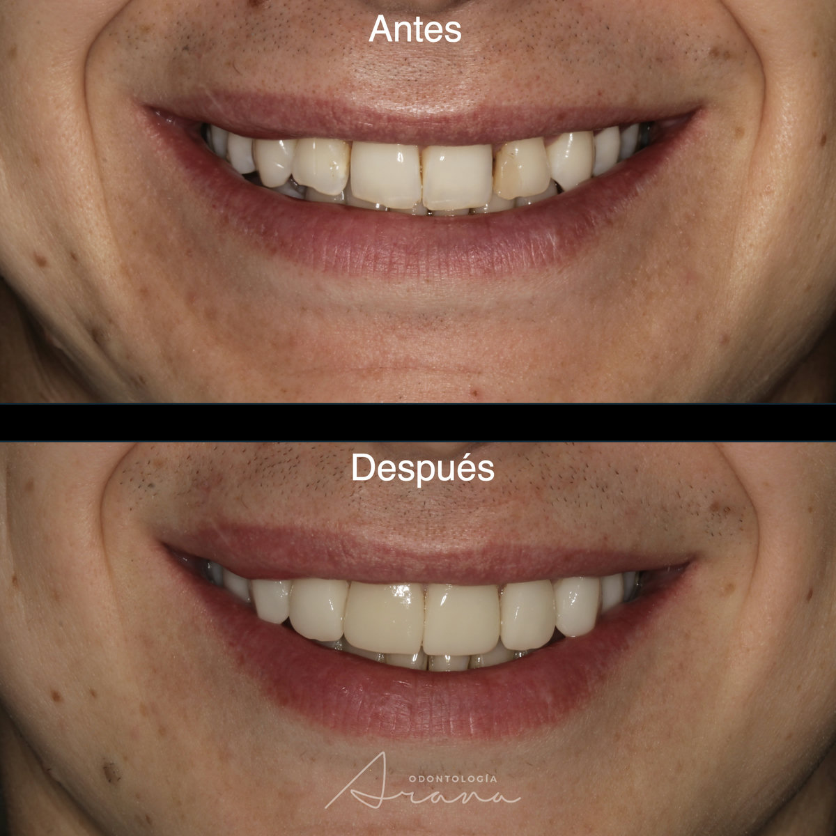 Carillas cerámicas — sonrisa antes y después