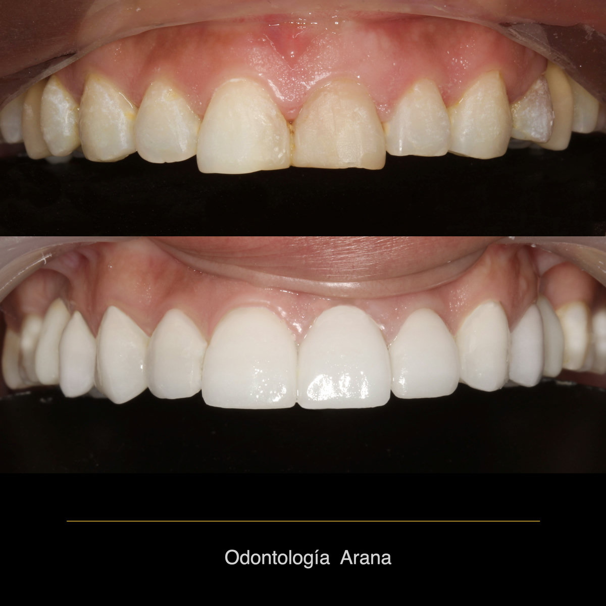 Carillas cerámicas — vista intraoral antes y después