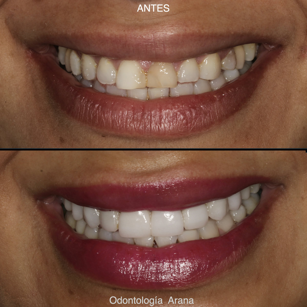 Carillas cerámicas — sonrisa antes y después