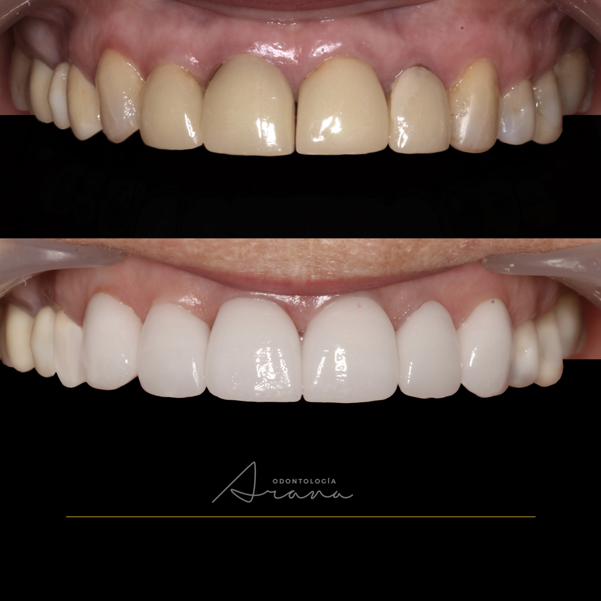 Carillas cerámicas — vista intraoral antes y después