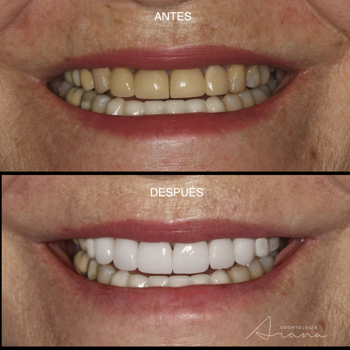 Carillas cerámicas — sonrisa antes y después