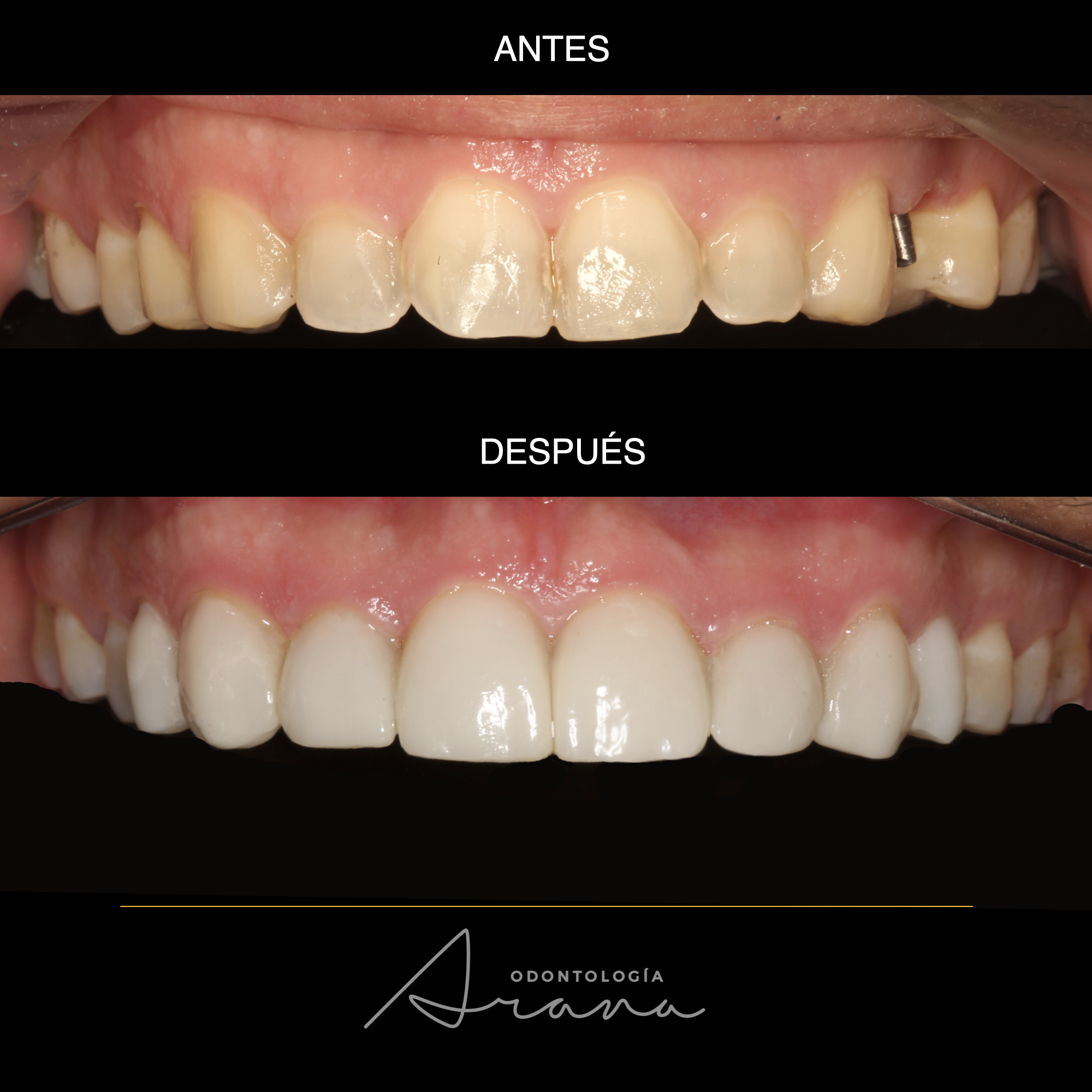 Carillas cerámicas — vista intraoral antes y después