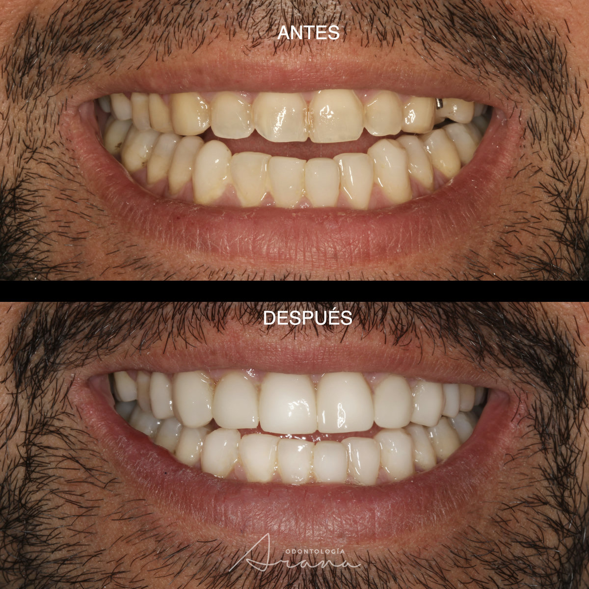 Carillas cerámicas — sonrisa antes y después