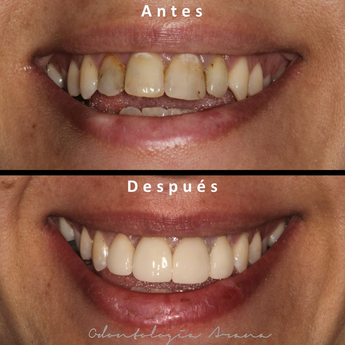 Carillas cerámicas — sonrisa antes y después