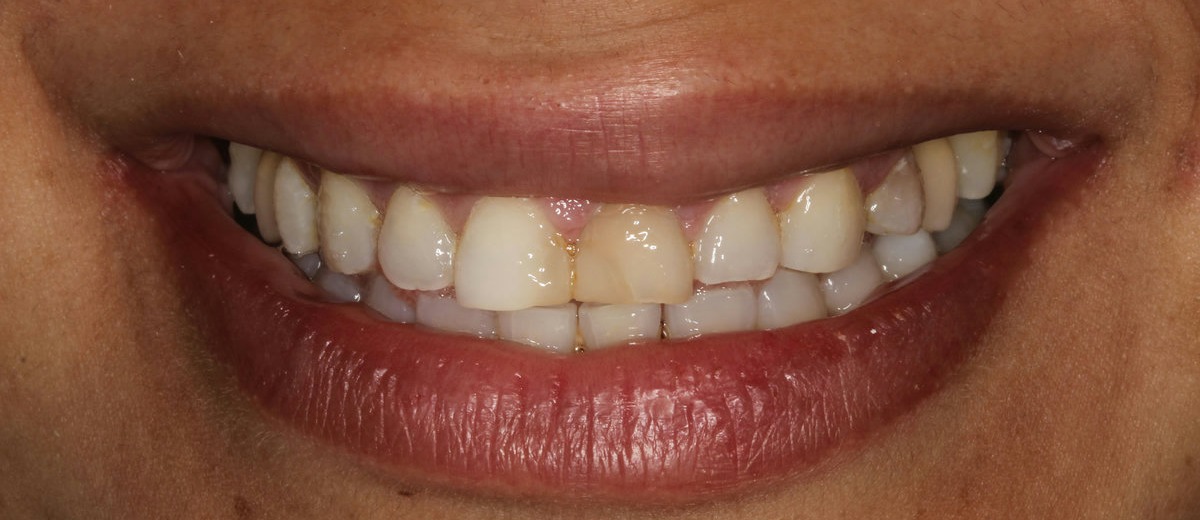 Sonrisa antes del tratamiento