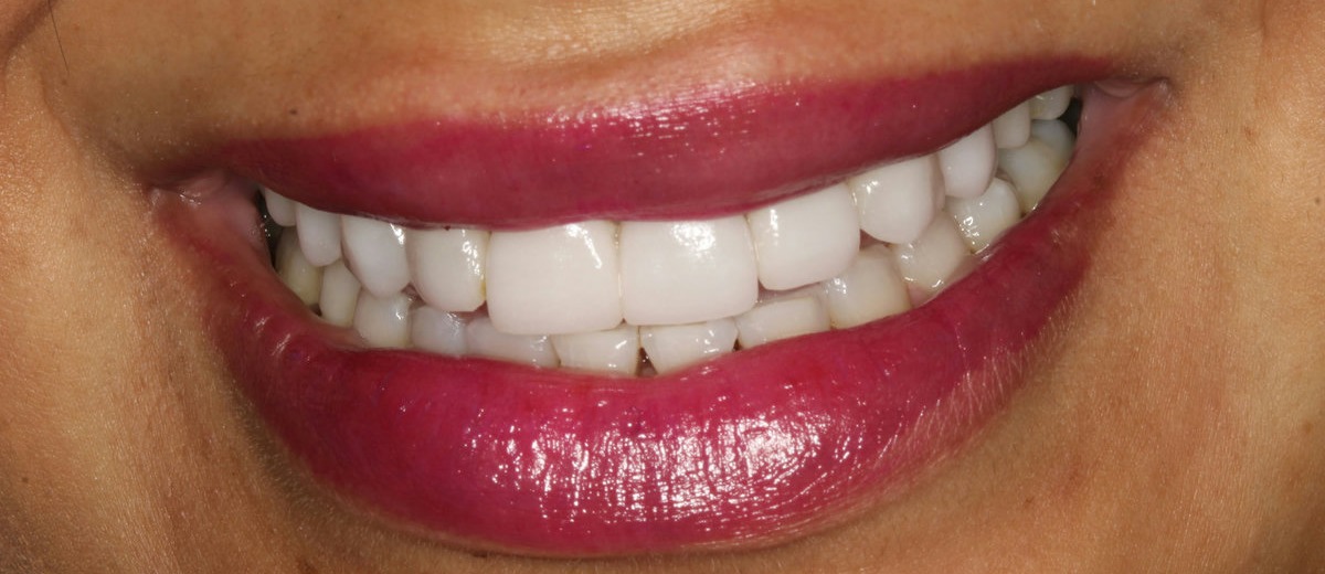 Sonrisa después del tratamiento