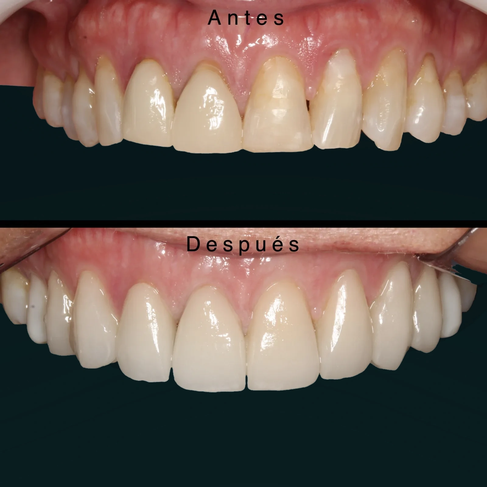 Antes y después intraoral en caso de carillas