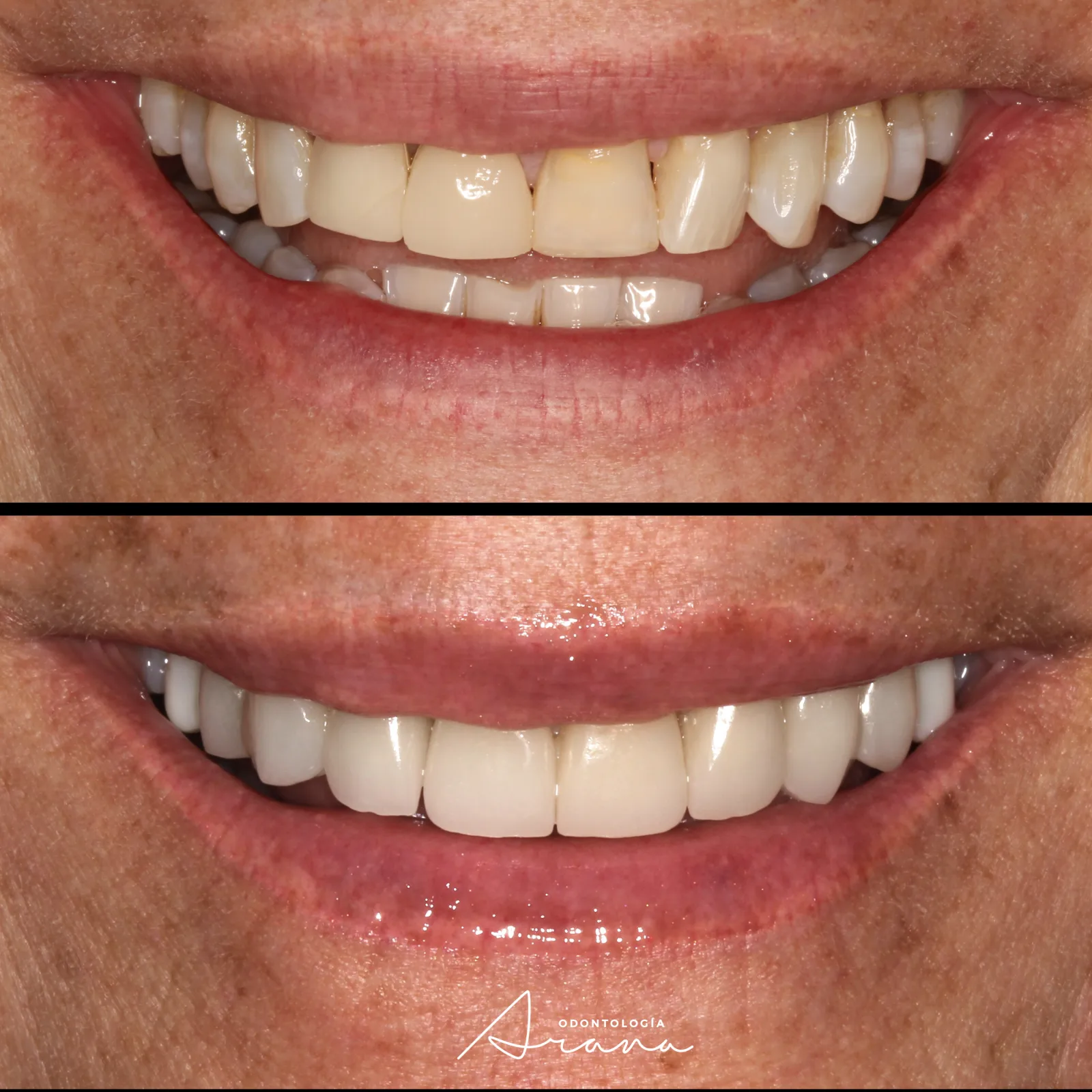 Antes y después de sonrisa en caso de carillas