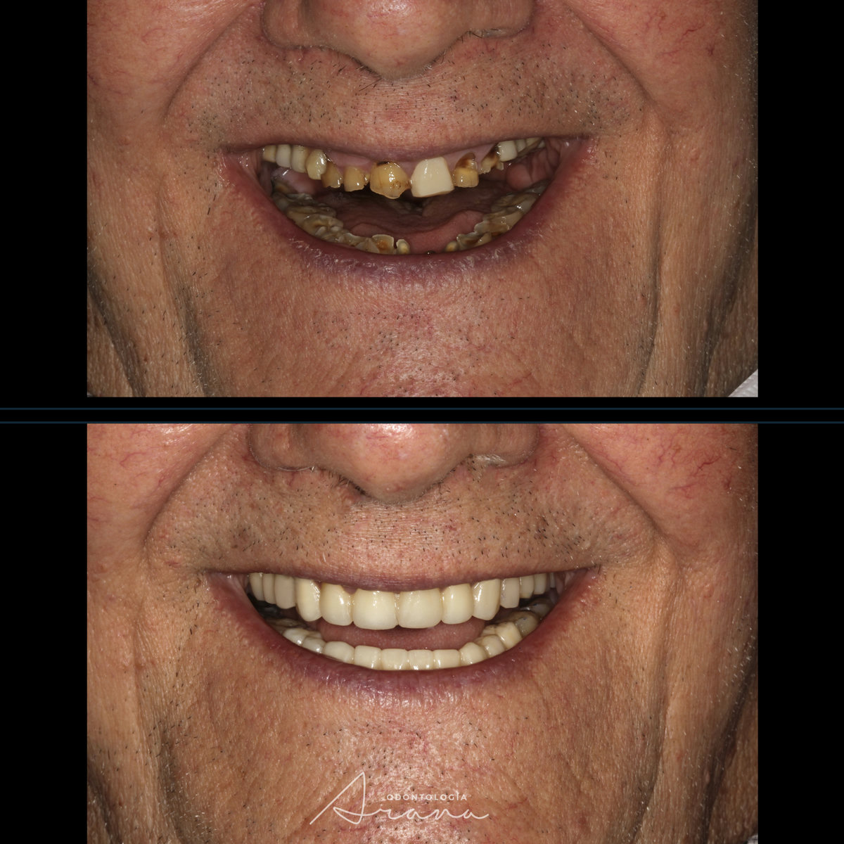 Rehabilitación oral — sonrisa antes y después