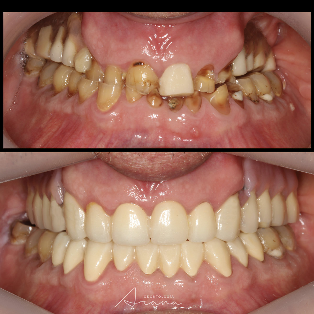 Rehabilitación oral — vista intraoral antes y después