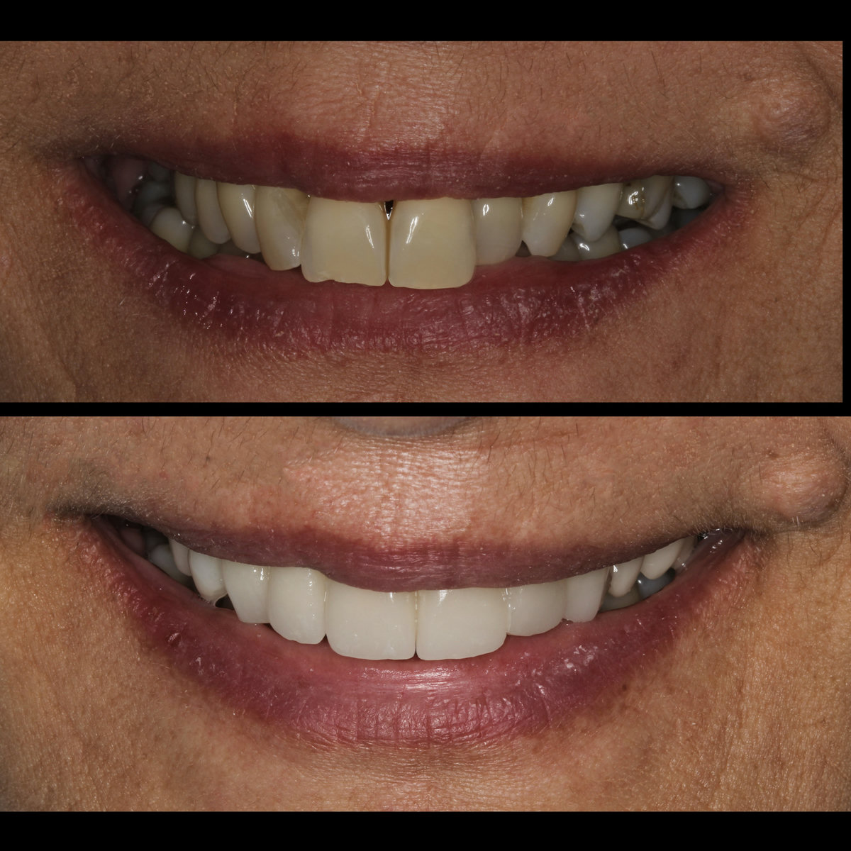 Rehabilitación oral — sonrisa antes y después