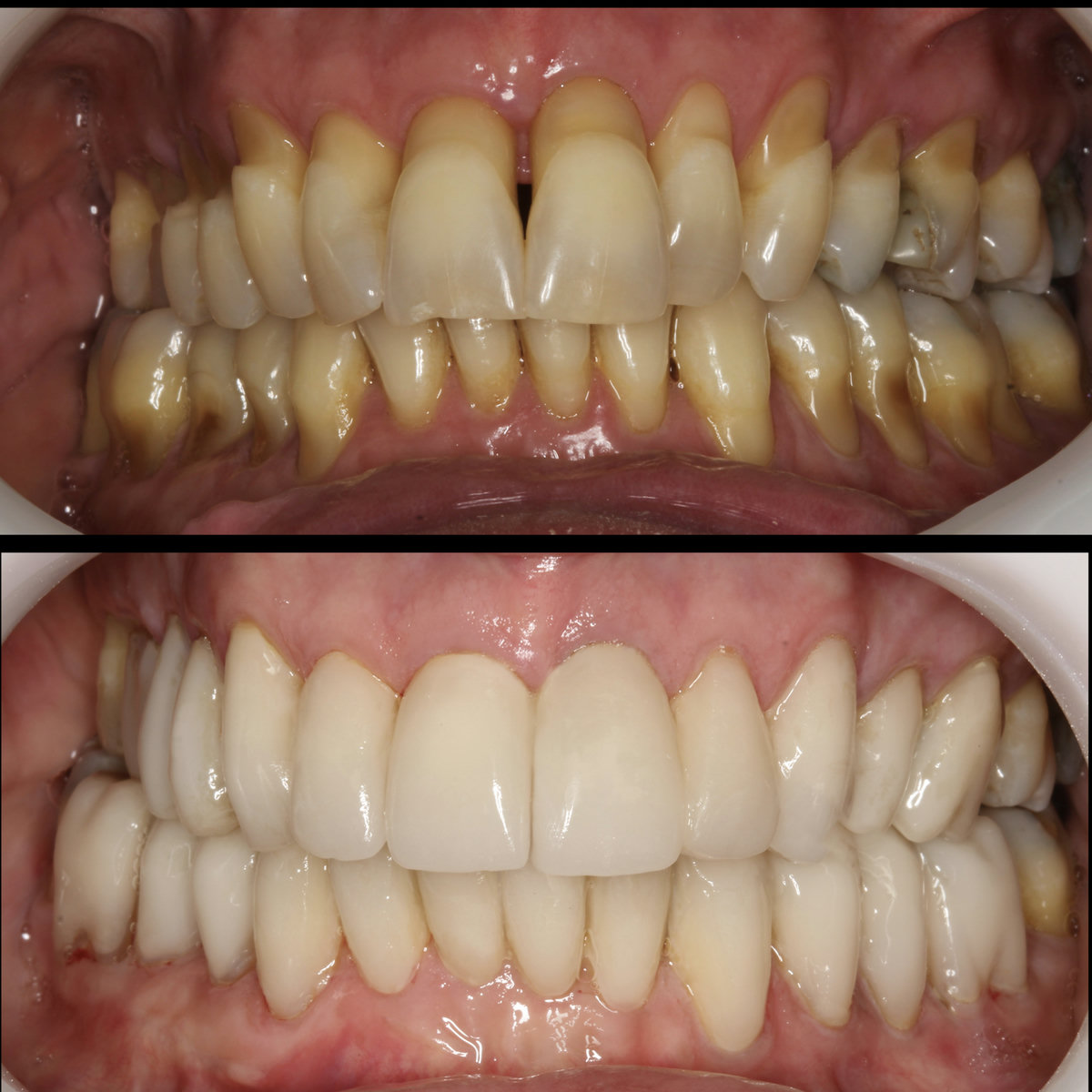 Rehabilitación oral — vista intraoral antes y después