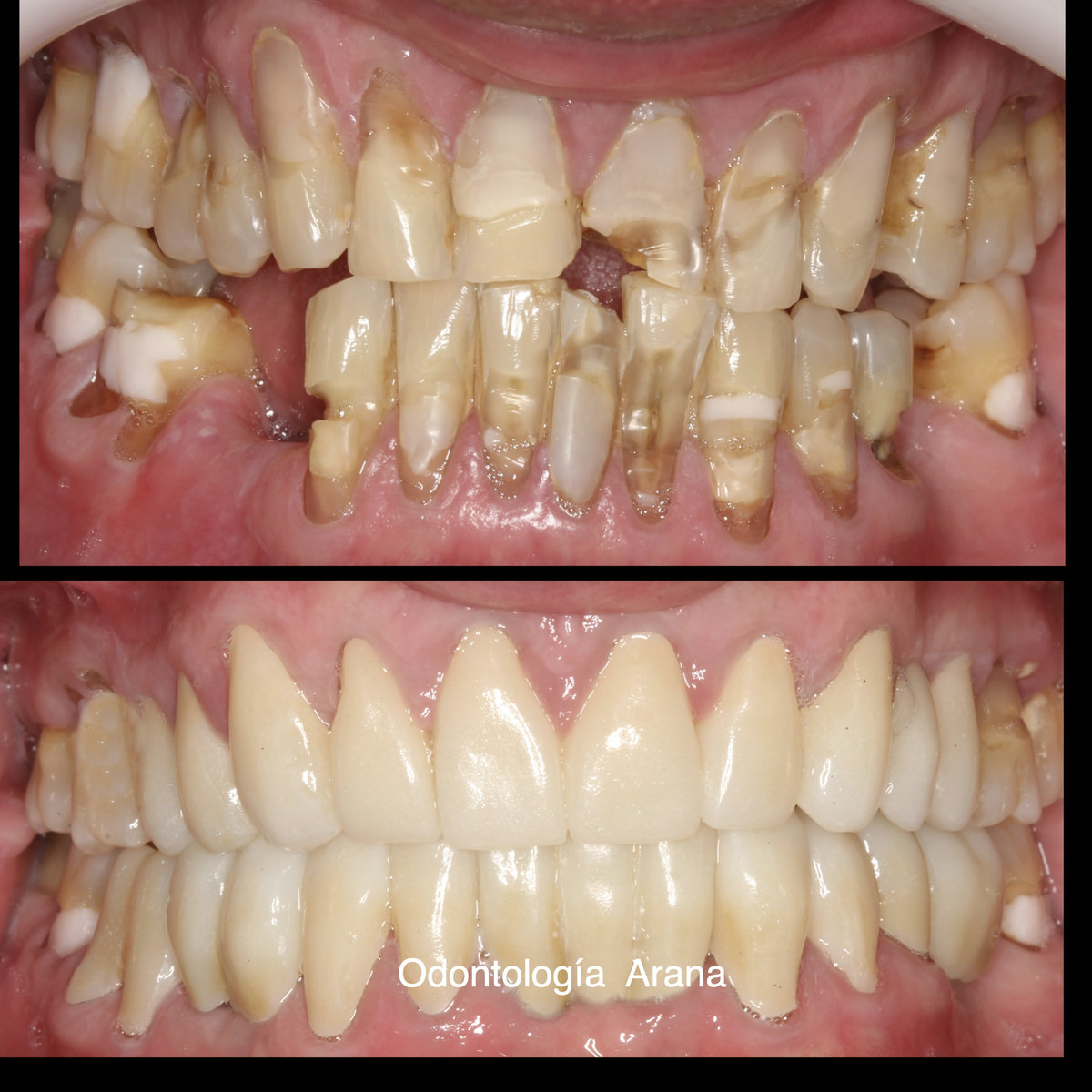 Rehabilitación oral — vista intraoral antes y después