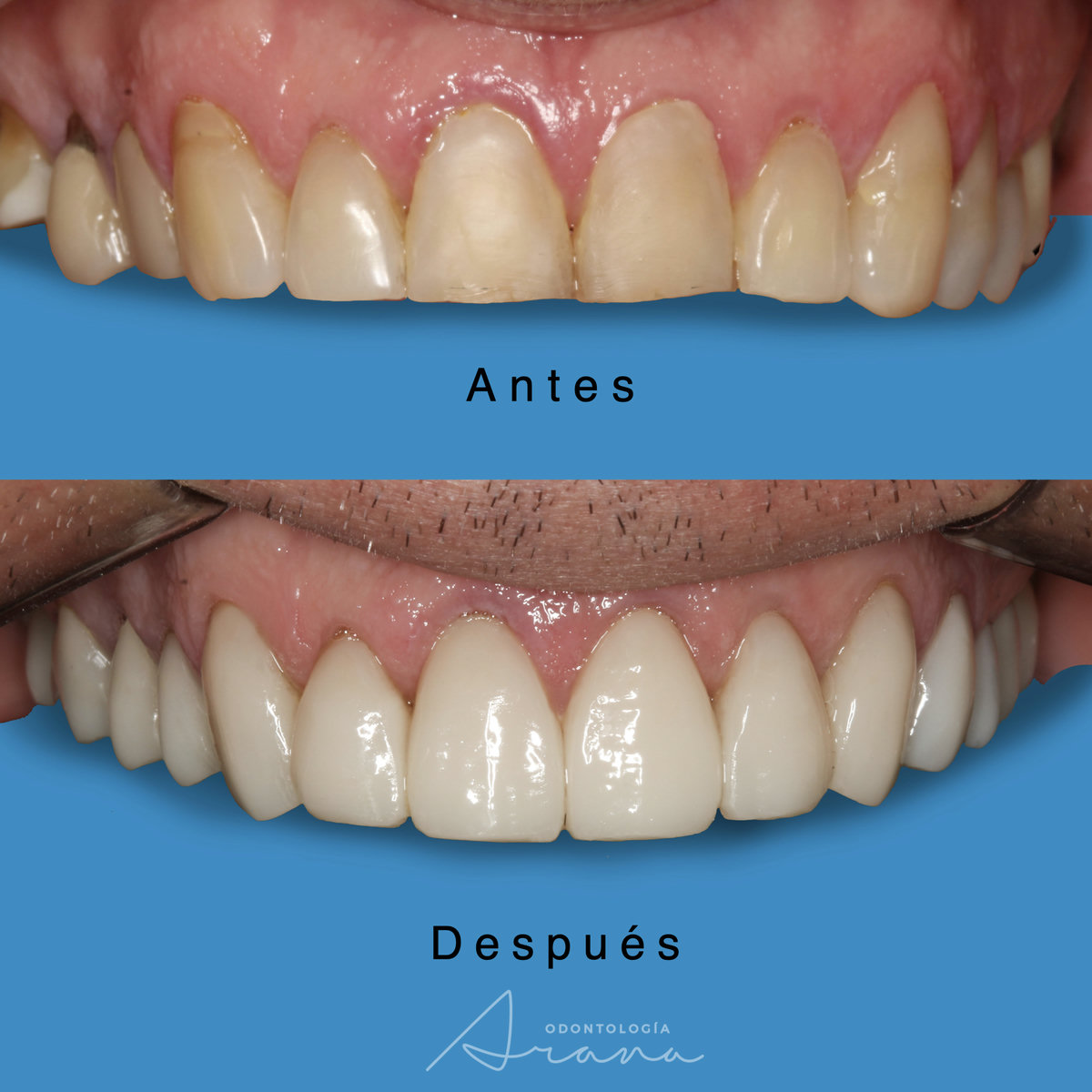 Rehabilitación oral — vista intraoral antes y después