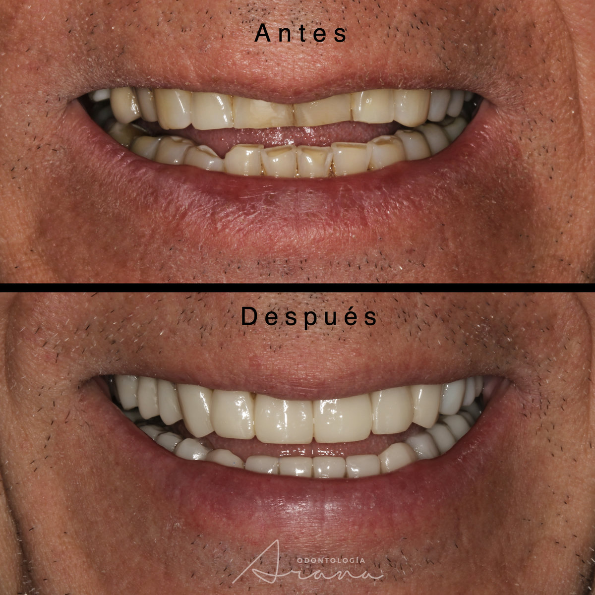 Rehabilitación oral — sonrisa antes y después