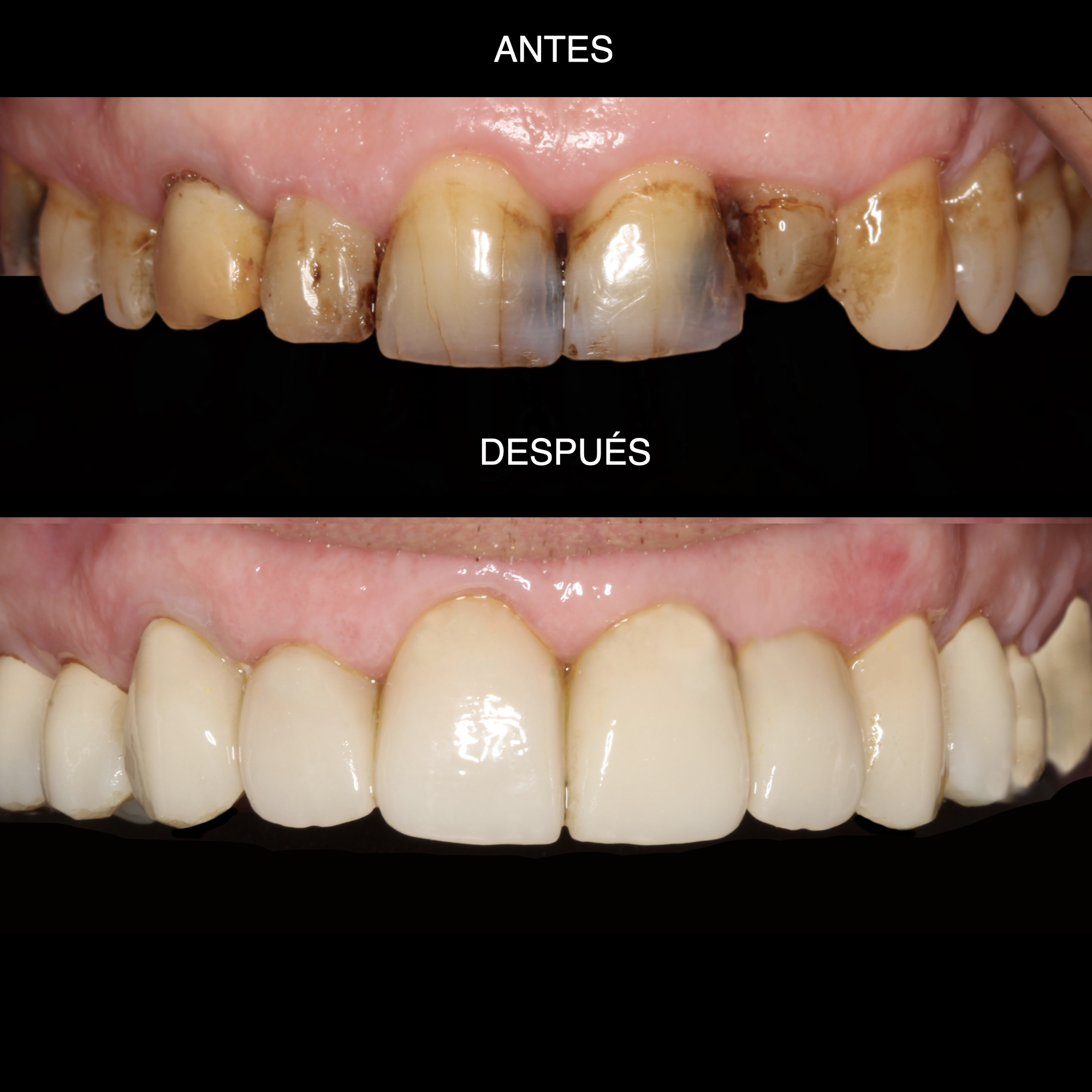 Rehabilitación oral — vista intraoral antes y después