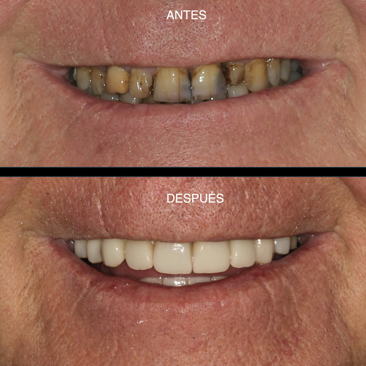 Rehabilitación oral — sonrisa antes y después
