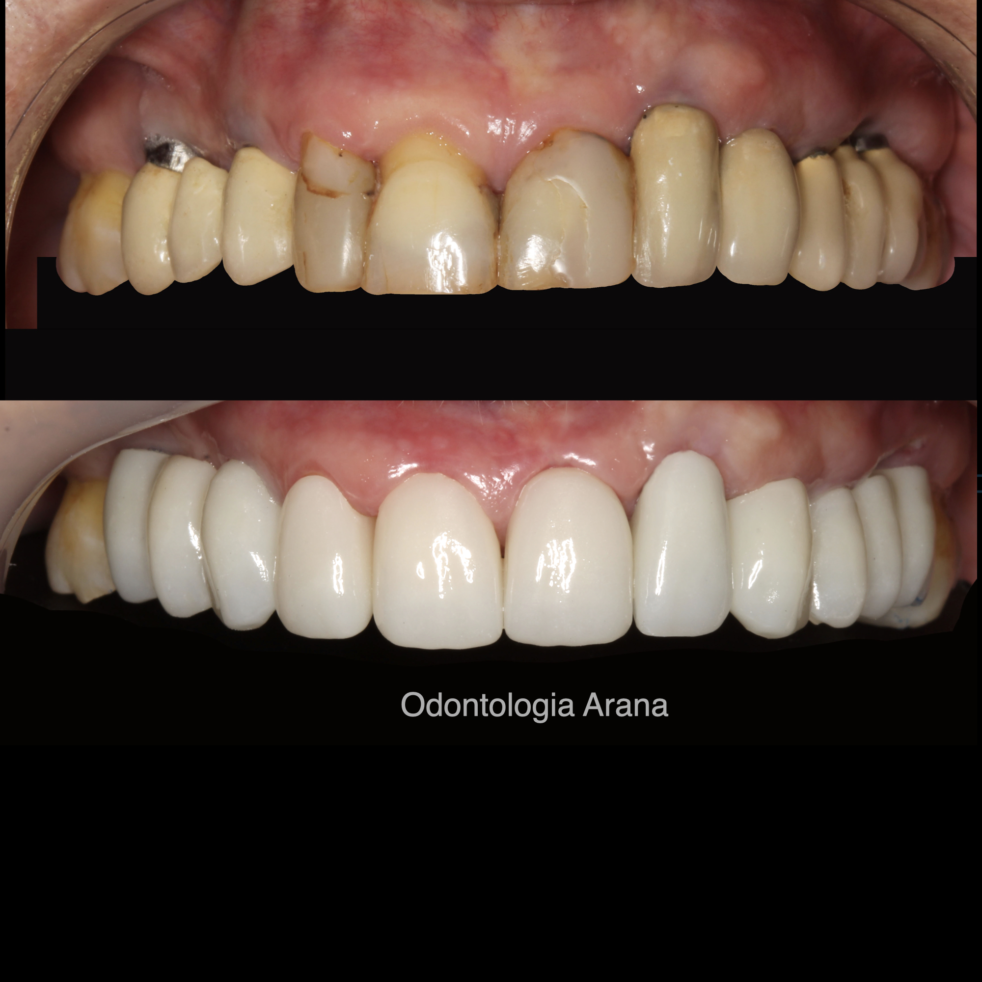 Rehabilitación oral — vista intraoral antes y después