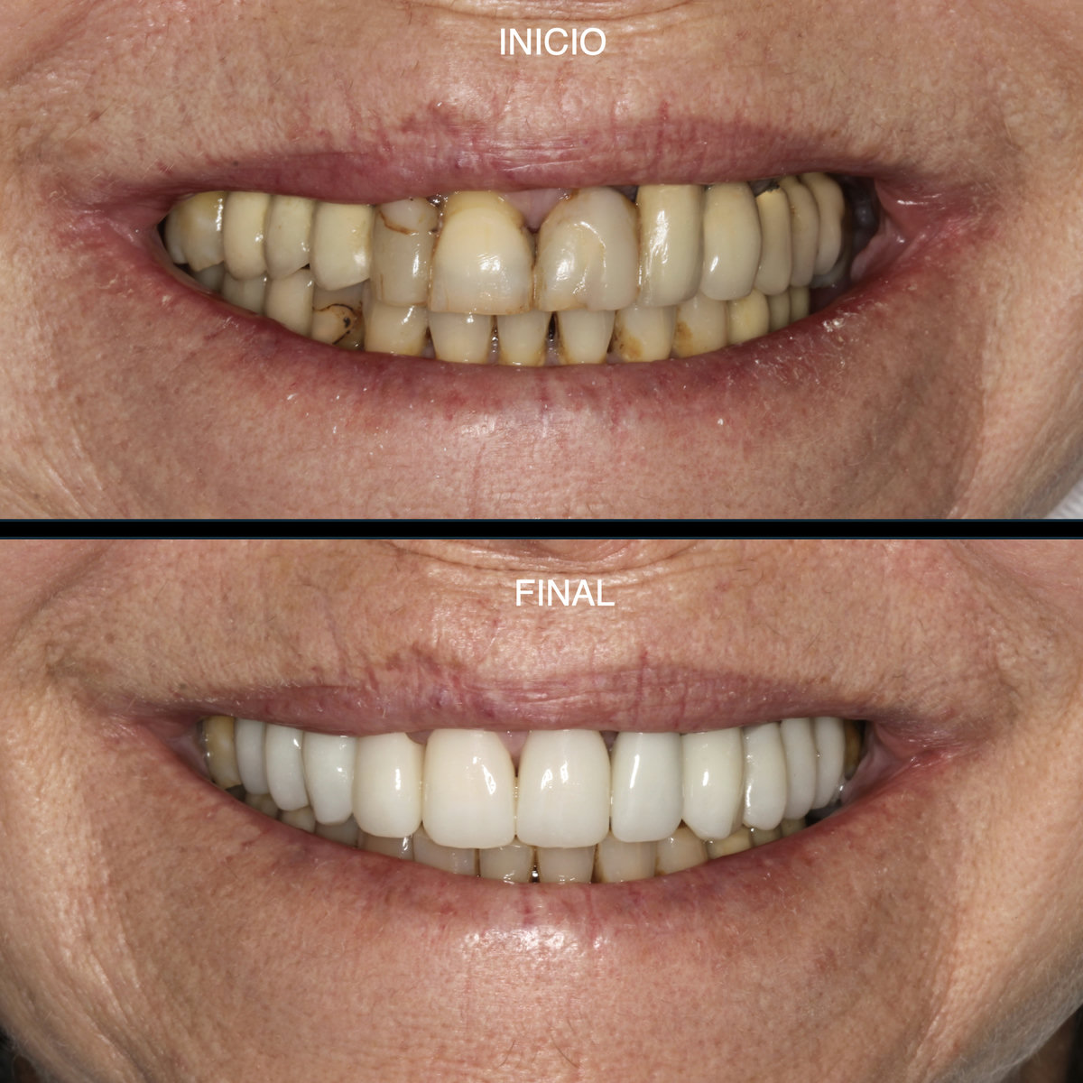 Rehabilitación oral — sonrisa antes y después