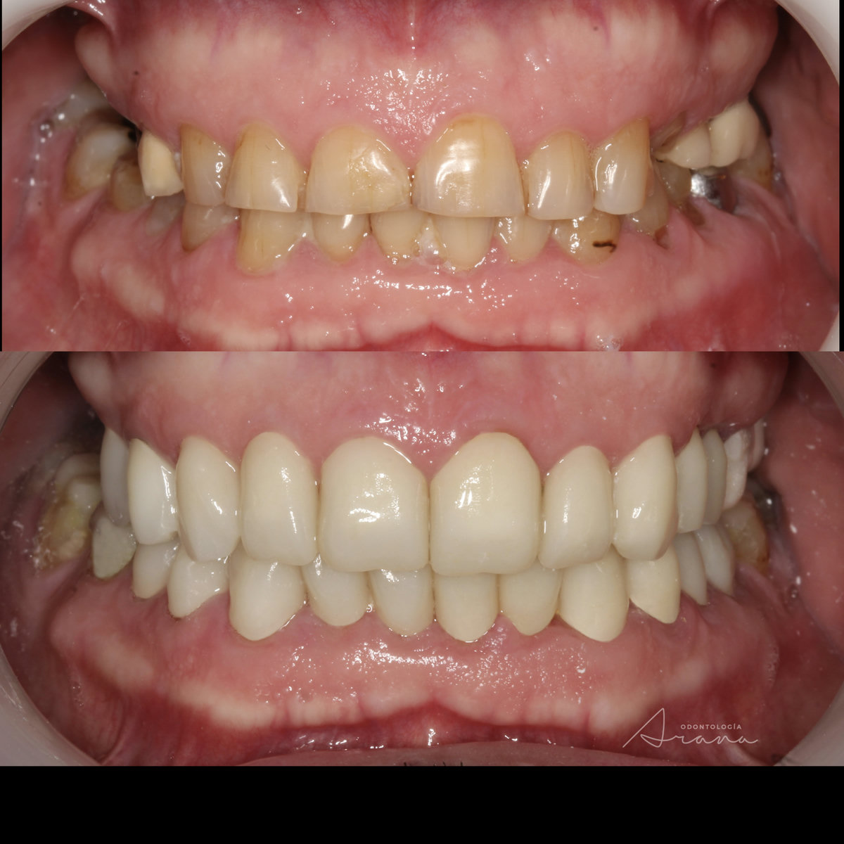 Rehabilitación oral — vista intraoral antes y después