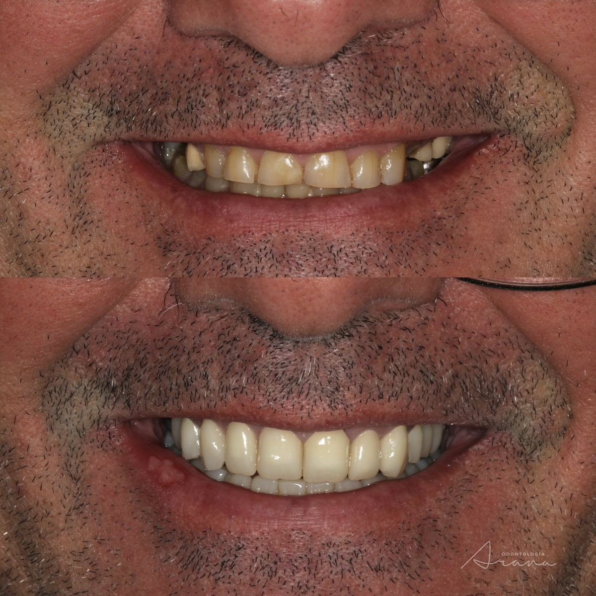 Rehabilitación oral — sonrisa antes y después